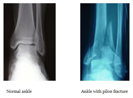 Pilon Fracture ankle